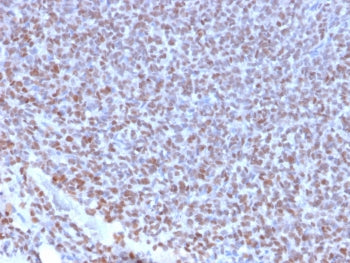 IHC testing of FFPE Ewings sarcoma with recombinant NKX2.2 antibody (clone NX2/2198R). HIER: steam s