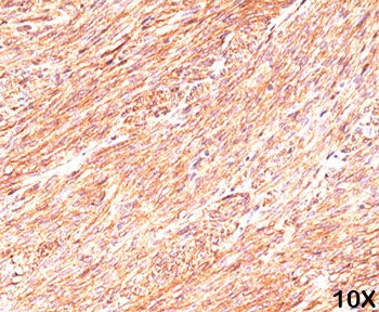 Formalin/paraffin human gastrointestinal stromal tumor (10X) stained with TMEM16A antibody (clone DG