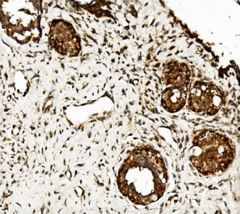 IHC staining of FFPE human breast cancer with CLPB antibody. HIER: boil tissue sections in pH8 EDTA 