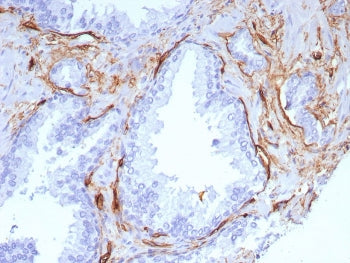 IHC staining of FFPE human colon cancer tissue with CD34 antibody (clone rHPCA1/8573). HIER: boil ti
