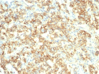 IHC staining of FFPE human bladder tissue with S100A14 antibody (clone S100A14/7403). HIER: boil tis