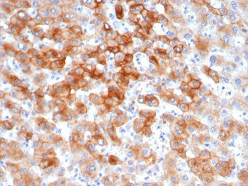 IHC staining of FFPE human colon tissue with recombinant Keratin 8 antibody (clone KRT8/6472R). HIER: boil tissue sections in pH 9 10mM Tris with 1mM EDTA for 20 min and allow to cool before testing.