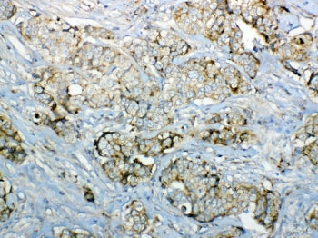 IHC testing of FFPE human breast cancer tissue with GALNS antibody at 1ug/ml. Required HIER: steam s