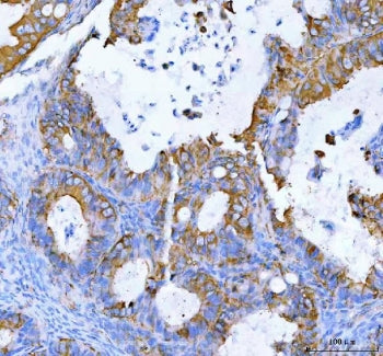 IHC staining of FFPE human ovarian serous adenocarcinoma tissue with MOGAT2 antibody. HIER: boil tis