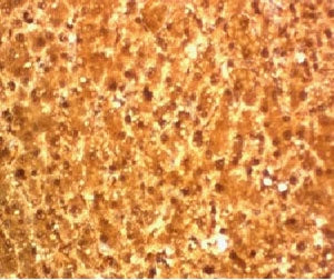 IHC testing of FFPE human hepatocellular carcinoma and Arginase 1 antibody.