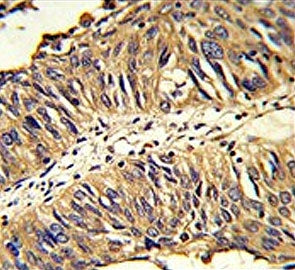 IHC testing of FFPE human lung carcinoma tissue with PDIA3 antibody. HIER: steam section in pH6 citr