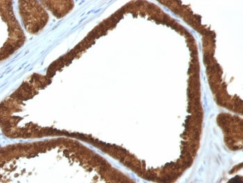 IHC: Formalin-fixed, paraffin-embedded human colon carcinoma stained with IDH1 antibody (clone IDH1/