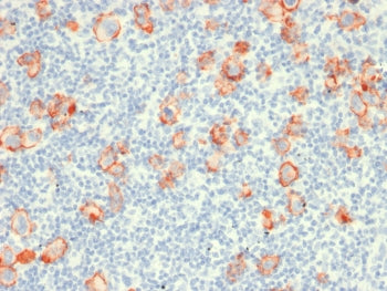 IHC testing of FFPE Hodgkin's Lymphoma with recombinant CD30 antibody (clone rCD30/412). Required HI