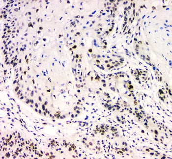 IHC staining of FFPE human esophagus squama cancer with BCL9L antibody. HIER: boil tissue sections i
