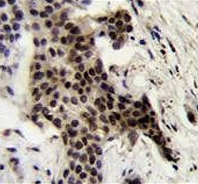IHC testing of FFPE human bladder carcinoma tissue with UBXN2A antibody. HIER: steam section in pH6 