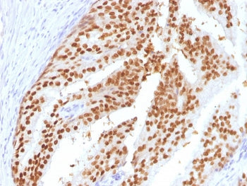 IHC testing of FFPE human PIN (Prostatic Intraepithelial Neopplasia) with FOXA1 antibody (clone FOXA