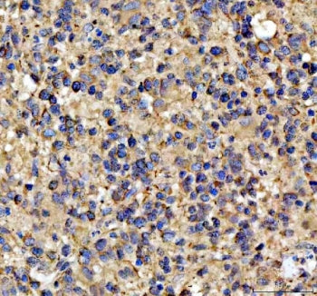 IHC staining of FFPE human glioblastoma tissue with NOTCH2 antibody. HIER: boil tissue sections in p