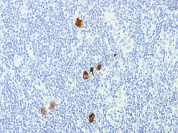 IHC staining of FFPE Hodgkin's Lymphoma with EBV antibody cocktail (clone CS1-4). HIER: boil tissue 