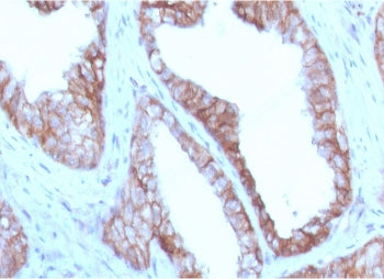 IHC staining of FFPE human prostate carcinoma with CD47 antibody (clone CDLA47-1). HIER: boil tissue
