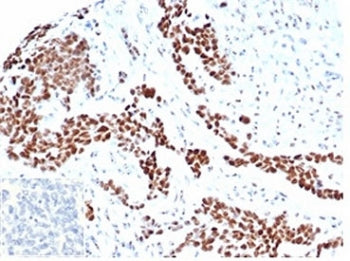 IHC staining of FFPE human ovarian carcinoma tissue with recombinant WT1 antibody (clone rWT1/6908).