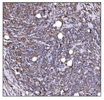 IHC staining of FFPE human lymphoma tissue with LIR-1 antibody. HIER: boil tissue sections in pH8 ED