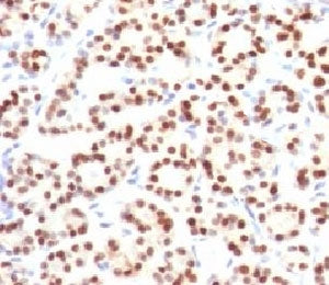 IHC testing of FFPE human thyroid tissue with TTF-1 antibody (clone HBNK2-1). Required HIER: boil FF