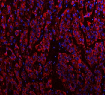 Immunofluorescent staining of FFPE human liver cancer tissue with IDH3A antibody (red) and DAPI nucl