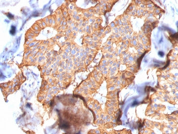 IHC staining of FFPE human breast carcinoma with HER2 antibody (clone SPM172). HIER: boil tissue sec