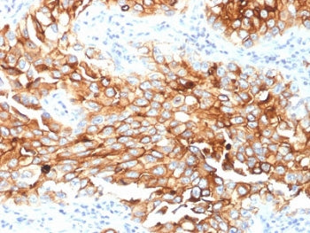 IHC testing of FFPE human lung mesothelioma with Mesothelin antibody (clone MSLN/2131). HIER: boil t