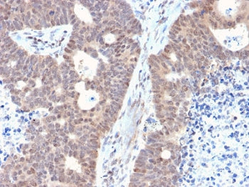 IHC testing of FFPE human colon carcinoma with FAF1 antibody. HIER: boiling tissue sections in 10mM 