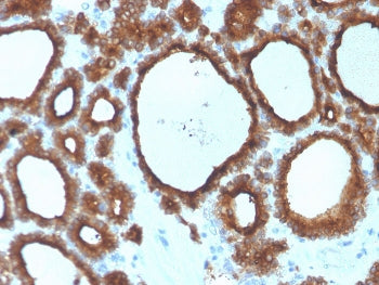 IHC staining of FFPE human thyroid carcinoma with Thyroid Peroxidase antibody. HIER: boil tissue sec