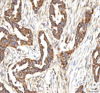 IHC staining of FFPE human pancreas ductal adenocarcinoma tissue with ITPA antibody. HIER: boil tiss