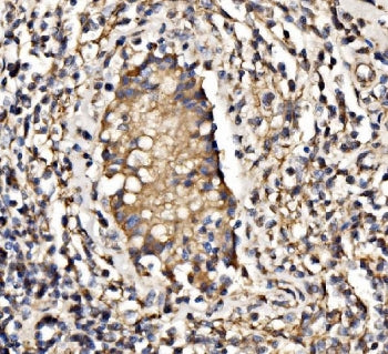 IHC staining of FFPE human testicular cancer tissue with PIK3R1 antibody. HIER: boil tissue sections