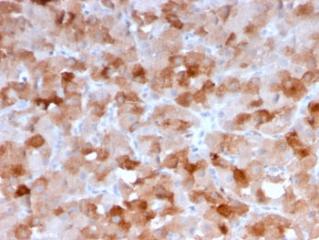 IHC staining of FFPE human squamous cell carcinoma with VISTA antibody (clone VISTA/3007). HIER: boi