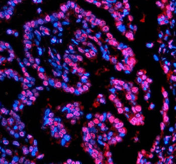 Immunofluorescent staining of NUPR1 using anti-NUPR1 antibody (red). NUPR1 was detected in a paraffi