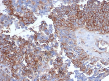 IHC staining of FFPE human ovarian carcinoma tissue with recombinant N-Cadherin antibody (clone CDH2