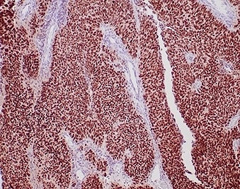 IHC staining of FFPE human urothelial carcinoma tissue with recombinant GATA Binding Protein 3 antib