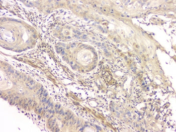 IHC staining of FFPE human esophageal squamous cancer with CCR10 antibody at 1ug/ml. HIER: boil tiss