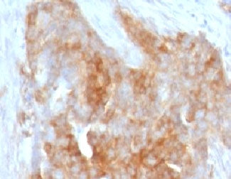 IHC testing of FFPE human ovarian carcinoma with Fascin antibody (clone FAN55-1). Staining of formal
