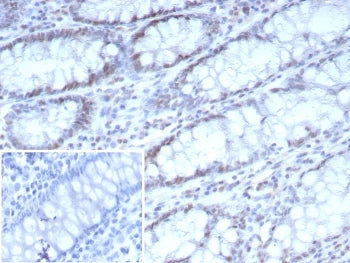 IHC staining of FFPE human colon carcinoma tissue with Cyclin-dependent kinase 4 antibody (clone CDK