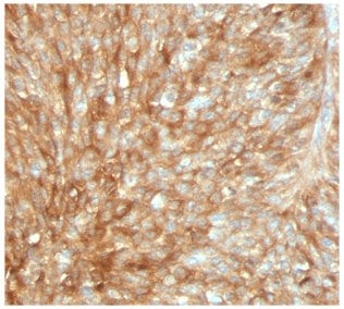 IHC testing of FFPE human bladder carcinoma stained with recombinant Beta-2-Microglobulin antibody (
