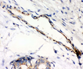 IHC testing of FFPE human breast cancer with Caldesmon antibody (clone CD-7). HIER: steamed with pH6