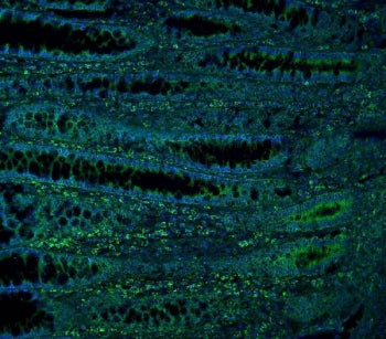 Immunofluorescent staining of FFPE human intestinal cancer with ME2 antibody (green) and DAPI nuclea