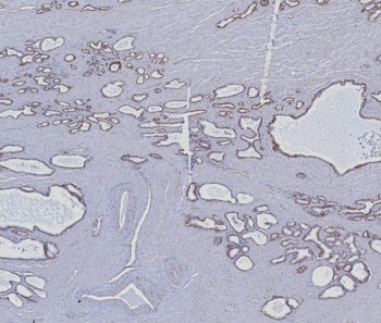 IHC staining of FFPE human prostate carcinoma tissue with Cytokeratin 5/6 antibody (clone KRT5.6/827