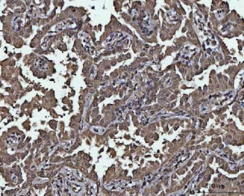 IHC staining of FFPE human lung cancer tissue with PP-X antibody. HIER: boil tissue sections in pH8 