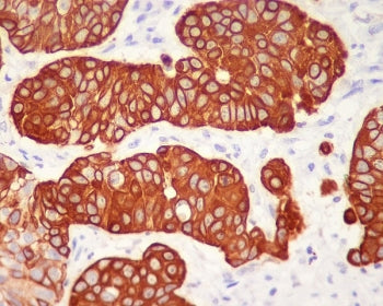 IHC staining of FFPE human urothelial carcinoma with KRT5 antibody. HIER: boil tissue sections in pH