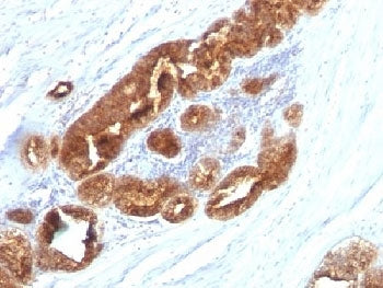 IHC analysis of formalin-fixed, paraffin-embedded human prostate carcinoma stained with TAG-72 antib