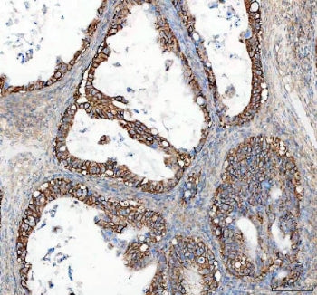 IHC staining of FFPE human ovarian cancer tissue with ATP1A1 antibody. HIER: boil tissue sections in