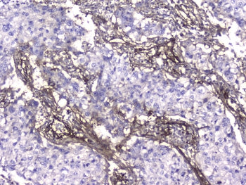 IHC testing of FFPE human lung cancer with Collagen IV antibody at 2ug/ml. HIER: boil tissue section