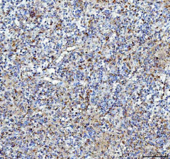 IHC staining of FFPE human glioma tissue with Pleiotrophin antibody, HRP-labeled secondary and DAB s