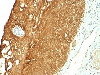 IHC: Formalin-fixed, paraffin-embedded human cervical carcinoma stained with CK19 antibody (clone KR