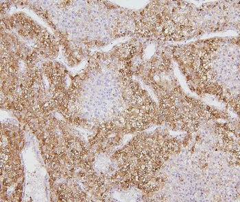 IHC staining of FFPE human liver cancer with CYP2E1 antibody. HIER: boil tissue sections in pH6, 10m