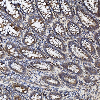 IHC staining of FFPE human rectal cancer tissue with ZO2 antibody. HIER: boil tissue sections in pH8