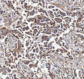 IHC staining of FFPE human breast cancer tissue with MCCC2 antibody. HIER: boil tissue sections in p