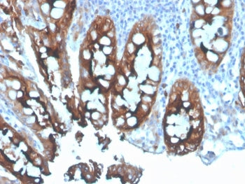 IHC staining of FFPE human colon carcinoma tissue with CEA antibody. HIER: boil tissue sections in p